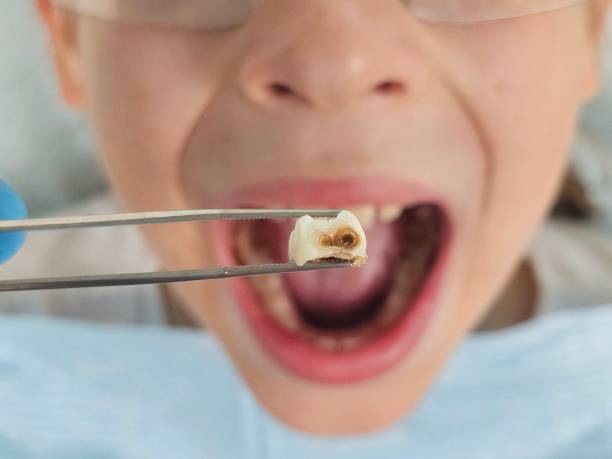 Best Emergency Tooth Extraction in Lillian, AL